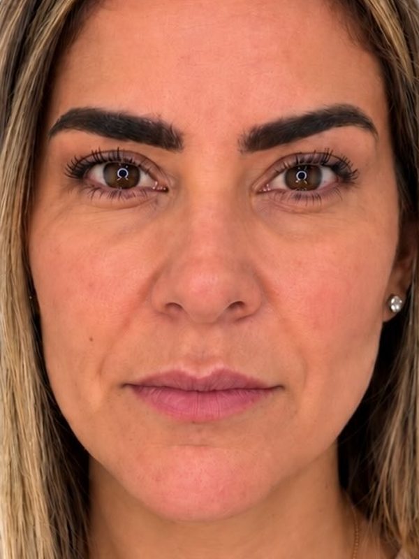 Rejuvenescimento facial, antes