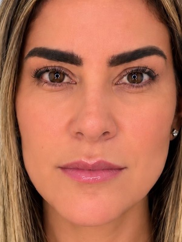 Rejuvenescimento facial, depois
