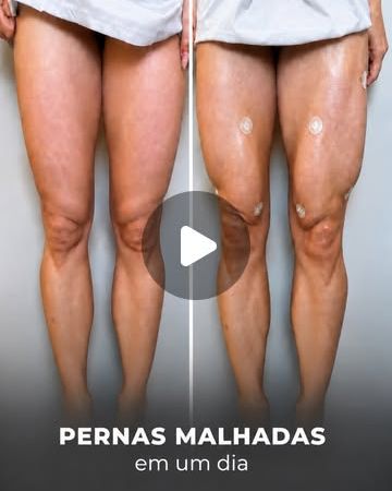 Pernas malhadas em um dia? Sim! Preenchimento de quadríceps com ácido hialurônico, sem cirurgia.
