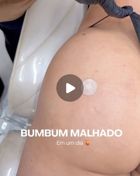 Bumbum malhado em 1 dia