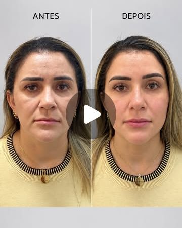 Antes e depois de harmonização facial
